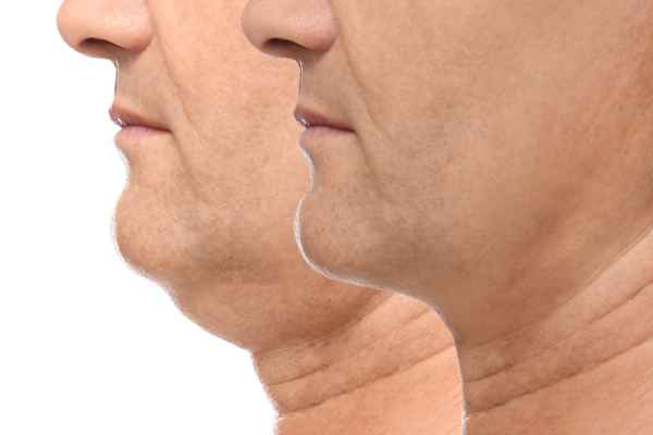 HIFU - Breakthrough in Anti - ageing 2 hifu results Watford