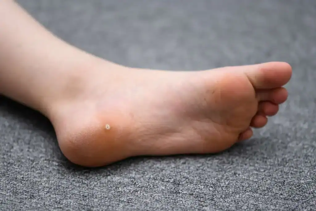 Cryotherapy For Warts And Also Verrucas 2 Image of verruca on the bottom of the foot that able to be treated with Cryotherapy Watford