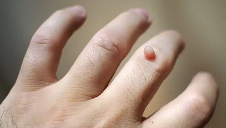 Cryotherapy For Warts And Also Verrucas 1 Image of blemish that Cryotherapy Watford can remove with Lipo 360.