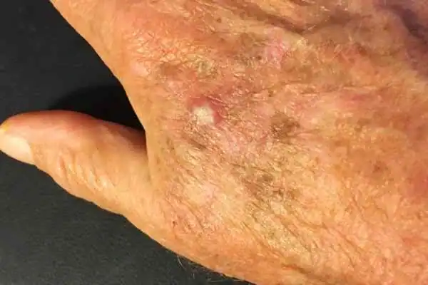 Cryopen For Actinic Keratoses 1 Image of Actinic keratoses Watford on a person hand