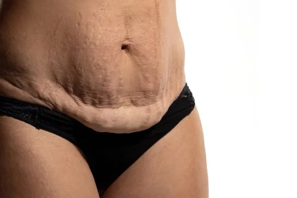 The science behind skin tightening Watford picture of a woman's sagging skin on the stomach